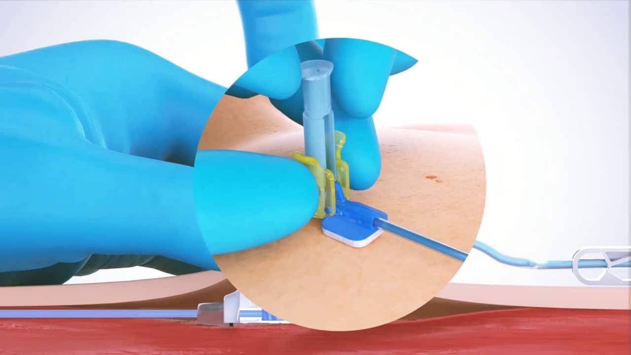 Video Thumbnail: PPS Safety Huber Needle - One-handed safety needle activation